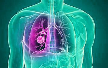 Cáncer de pulmón