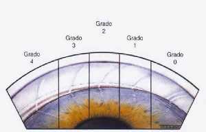 cuña corneal para gonioscopia