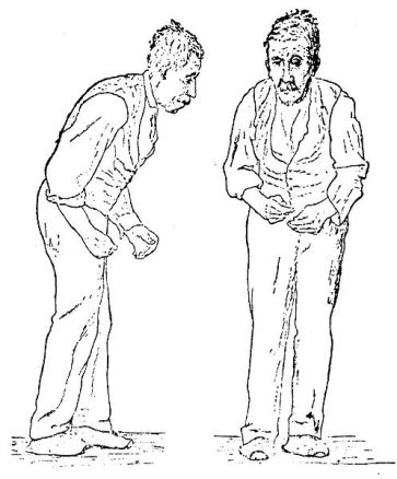 Sir William Richard Gowers Parkinson Disease sketch 1886