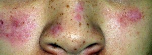 Lesiones eritematoescamosas en cara.