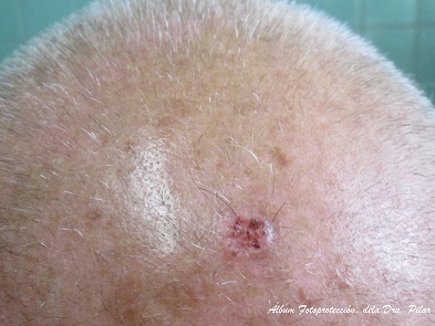 Lesión en cuero cabelludo