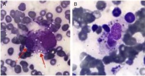 Histiocito con citoplasma vacuolado fagocitando una célula hematopoyética