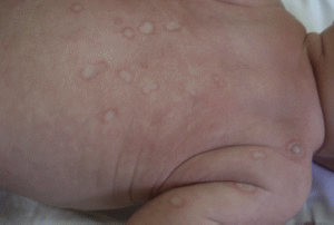 Síndrome de lupus neonatal inducido por anticuerpos antirribonucleoproteína