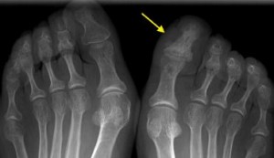Falange de marfil: un hallazgo específico y poco conocido en artritispsoriásica