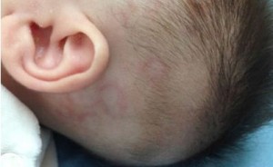 Lupus eritematoso neonatal: reporte de un caso