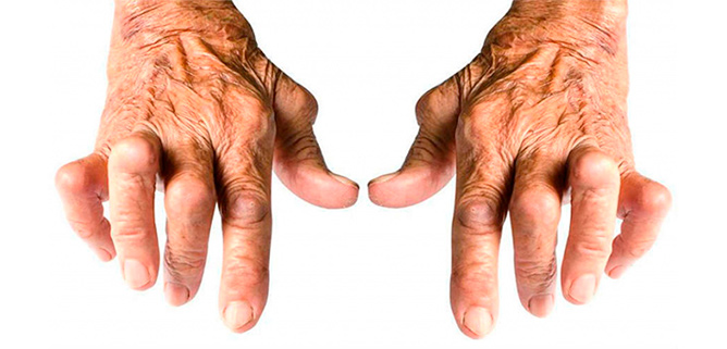 Las articulaciones de las manos son de las más afectadas por la enfermedad