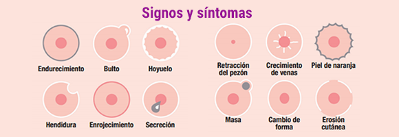 Signos y síntomas de cáncer de mama